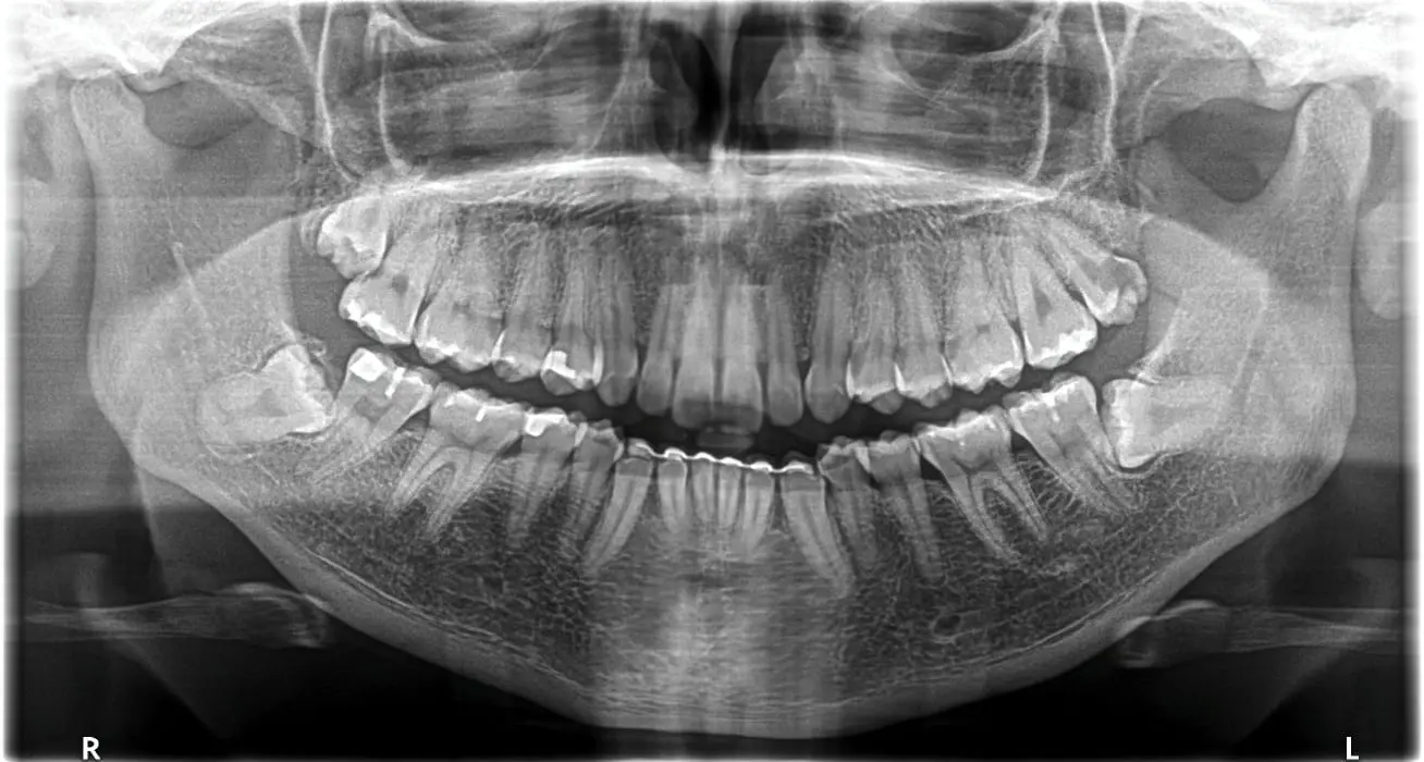 Radiografia panorâmica de dentes do siso inclusos e impactados